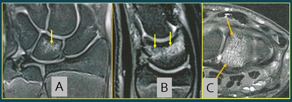  Fig. 5 : BMES en el área media y distal del SE, no estando afectada su área proximal.