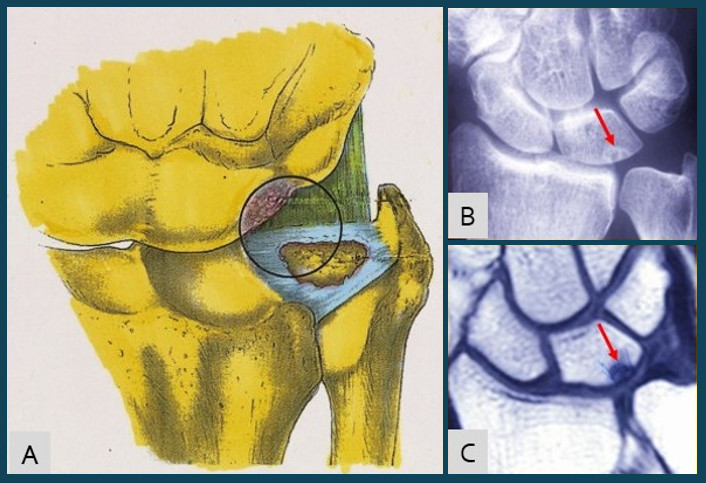 Fig.8.A: Impacto Cúbito-SE, por lesión crónica del ligamento triangular (dibujo cortesía Dr. JL. Haro) .B,C: caso clínico de BMES en una pequeña zona del SE. 